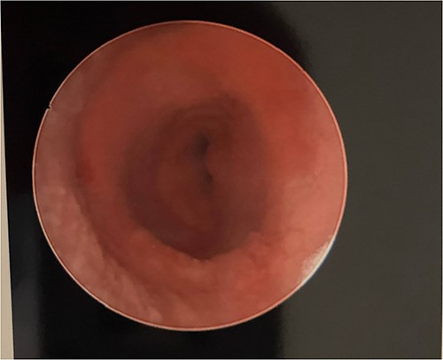 Postoperative vaginoscopy.