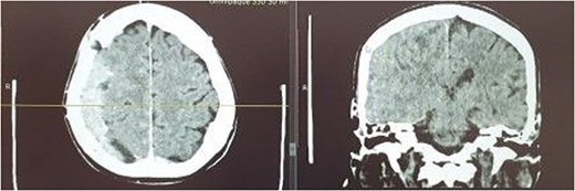 A non-contrast and contrast enhanced CT.