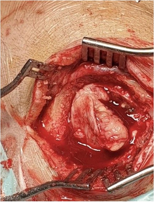 Intraoperative photo of tumorous mass.