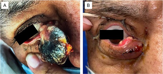 (A) Large sebaceous carcinoma of the right lower medial eyelid measuring ~2 × 3 cm. The fungating lesions appears necrotic with a light tan nodular base. (B) Sebaceous carcinoma 6 months post-excision with recurrent tan nodular lesions on the conjunctival surface, which were later re-excised during a conjunctival map biopsy procedure.