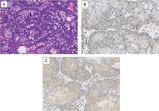 Histological images from the patient’s conjunctival map biopsy procedure. (A) H&E stained section showing tumor cells, some with vacuolated cytoplasm and others with a basaloid appearance. These features are consistent with well-differentiated sebaceous carcinoma. (B) Immunohistochemical staining for MLH1 shows loss of expression in the tumor cell nuclei. (C) Immunohistochemical staining for PMS2 shows loss of expression in the tumor cell nuclei. Normal stromal nuclei appear brown in images B and C, consistent with intact MLH1 and PMS2 staining.