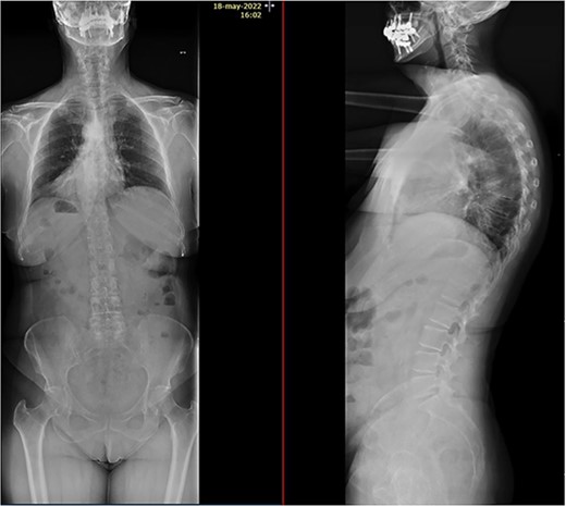 Complete spine X-rays showing a T7 compression fracture.