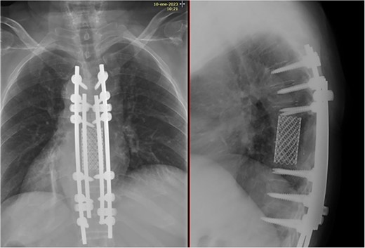 X-rays showing normal position of the implants with no signs of loosening.