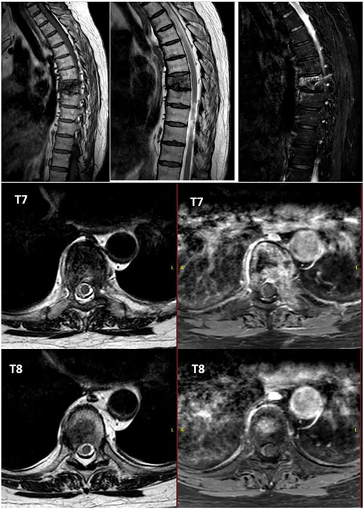 Alteration in the morphology and signal of the T7 vertebral body that presents a fracture with 30% loss of height and dorsal protrusion of posterior wall, with a left and epidural soft tissue component, the signal change extends to the left pedicle and part of the posterior arch. The right lateral margin of T8 vertebral body presents a hypointense signal on T1 and markedly hyperintense on STIR that indicates the presence of osseous edema. These findings suggest T7 pathological fracture and bone edema in the left T8 pedicle.