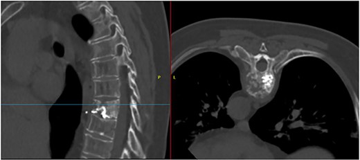 T7 pathological fracture with breakage of both superior and inferior end plates. Cement from the performed kyphoplasty is present, with leakage into the anterior paravertebral space.