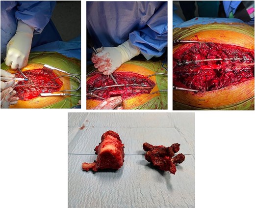 Total en bloc vertebrectomy of T7 and T8 and partial vertebrectomy of caudal T6.