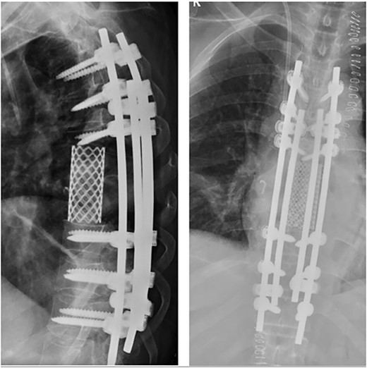 Anterior reconstruction with mesh and posterior reconstruction with T4T5T6, T9T10T11 screws, and double bar.