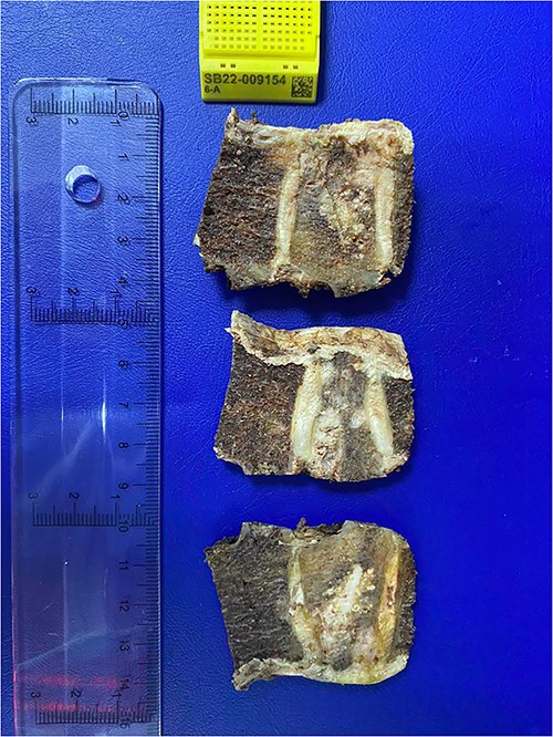 Histopathological exam, macroscopic study. A lobulated lesion (3.8 × 2.6 × 2.9 cm) involves 80% of the central vertebra (T7) and presents cartilaginous features. The lesion is confined to T7. Cavity filled with bone cement is present.