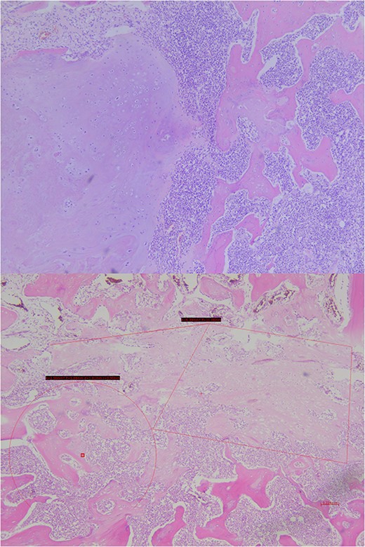 Histopathological exam, microscopic study. The lesion shows trabecular infiltration by hypercellular hyaline cartilage with cellular atypia, with no relevant mitotic activity. This tumor is confined to the central vertebra (D7) and does not extend further (R0). In the central portion, an abrupt transition to a high-grade neoplastic component of hematolymphoid type grows diffusely, composed by medium-large cells, with frequent mitosis. No extension to adjacent soft tissues or to the other vertebrae.