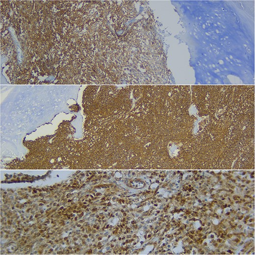 Immunohistochemical study shows how the described hematolymphoid neoplasia presents a immunophenotype typical of B germinal center. CD10+, CD20+, and BCL6+ are showed (from top to bottom).
