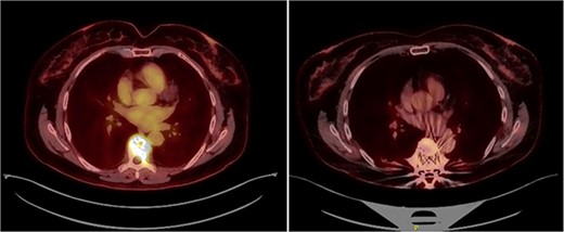 (left) PET scan prior to surgery showing pathological fracture at T7 with increased metabolical uptake (SUVmax 9.48). (right) PET scan by the end of fourth RCHOP cycle. No evidence of malignant disease. Slight metabolical uptake adjacent to spinal instrumentation (SUVmax 3.6) indicative of postsurgical changes.
