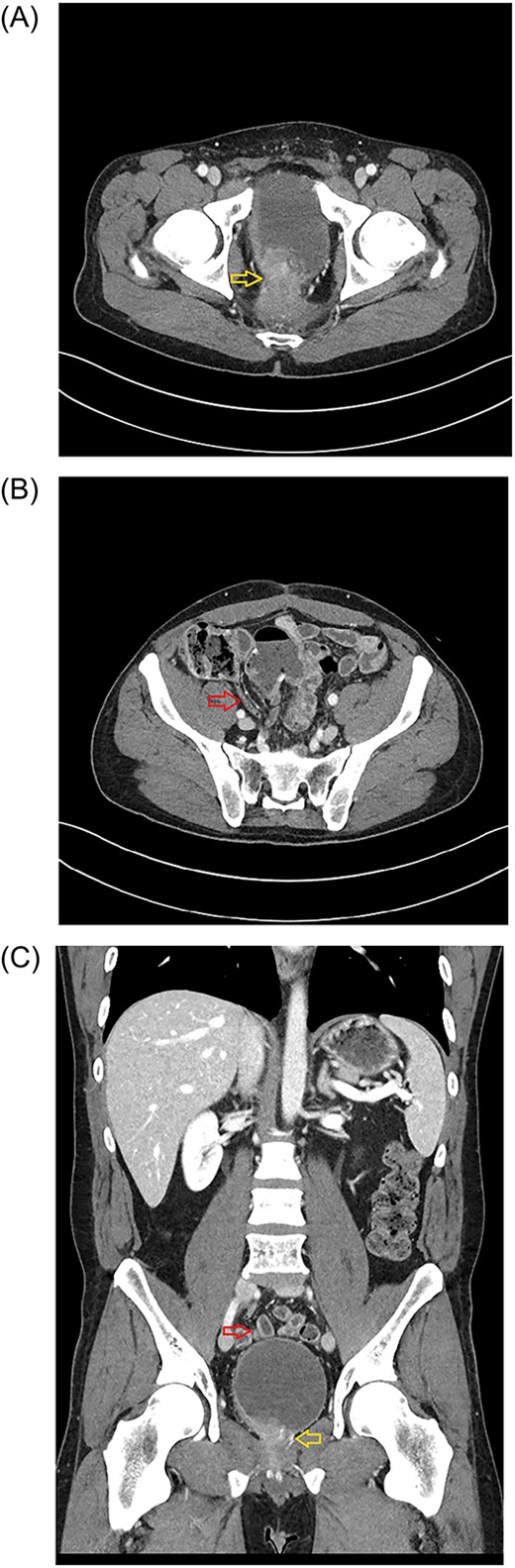 Axial plane of the abdominopelvic CT scan (January 2023) showing the tumor invading bladder (yellow arrow) (A) and the pelvic location of the appendix (red arrow) (B). Abdominal CT scan (Coronal plane) (C) showing the tip of appendix (upper, red arrow) and tumor invading bladder (lower, yellow arrow).