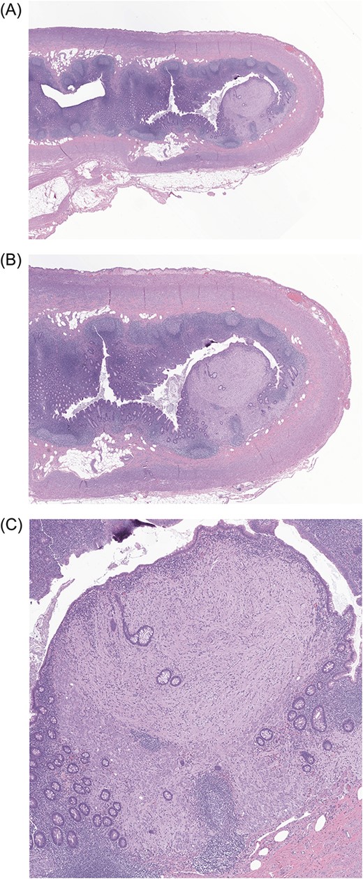 Low-power (5×, 10× and 40×) photomicrographs (A, B, C, respectively) of the patient’s appendix showing a solitary polypoid lesion located within the lamina propria of the appendiceal tip. The polypoid lesion is expanding the colonic lamina propria while displacing and distorting the adjacent colonic crypts.