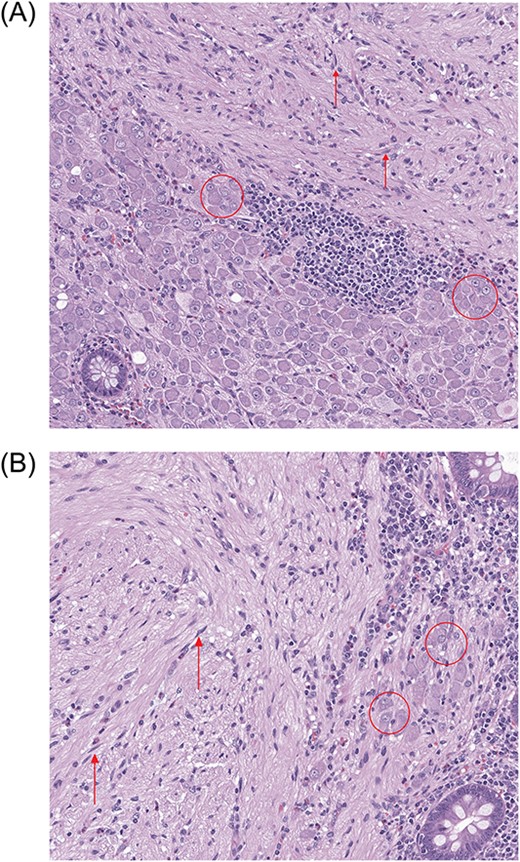 High-power (100×) photomicrographs (A, B) of the patient’s appendix. Stroma of the polypoid lesion is composed of spindle-shaped cells (arrows) with numerous ganglion cells (encircled) present predominantly at the periphery of the polypoid lesion.