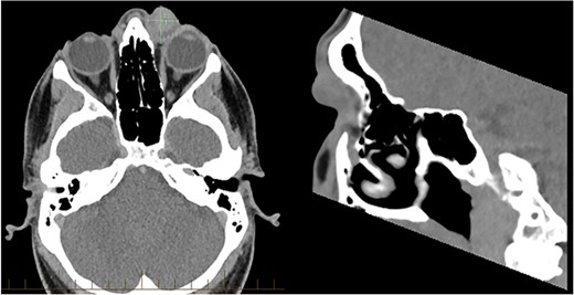 CT of the orbits demonstrated a 21 × 19 mm soft-tissue mass at the medial canthus with mass effect on the adjacent globe and no evidence of infiltration.