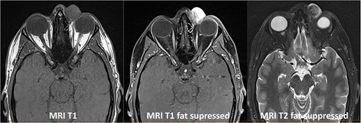 MRI of the orbits demonstrated a 20 × 18 mm well defined rounded mass arising within the medial canthus with no infiltration or bony erosion.