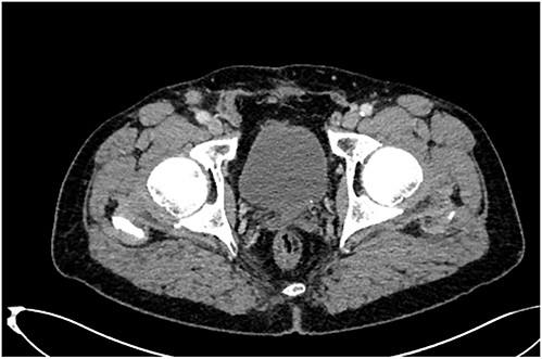 A right inguinal lymph node in a CT scan.