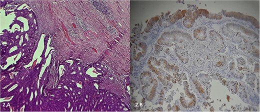 (A) Histological examination, after staining with hematoxylin and eosin, showing a lymph node parenchyma massively invaded by a carcinomatous proliferation consisting essentially of glands and cribriform structures lined by a cylindrical coating with pseudostratified nuclei, the site of moderate to significant cytonuclear atypia with several mitoses. (B) Immunohistochemical study showing a massive expression of cytokeratin 20.