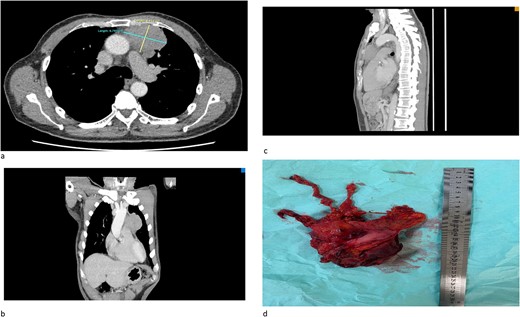 (a) An axial cut of a contrast-enhanced computed tomography (CECT) scan thorax showing an ill-defined anterior mediastinal mass measuring 4.8 cm × 6.7 cm. (b) A coronal view of a CT scan showing an ill-defined anterior mediastinal mass infiltrating the left upper and middle lobe lung. (c) A sagittal view of a CT scan showing an ill-defined anterior mediastinal mass. (d) A successful total thymectomy with R0 resection (microscopically margin-free resection) through a primary median sternotomy.
