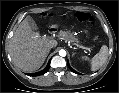 Preoperative CT-scan (arrow in the tumor).