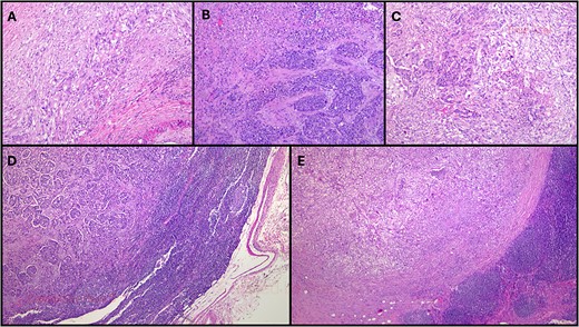 Histopathological examination of this case. (A) More than 60% of the neoplasm was composed of poorly-differentiated ductal adenocarcinoma (HE, original magnification 40×); (B). Over 30% of the neoplasm was composed of a large cell neuroendocrine carcinoma with a preserved organoid pattern (HE, original magnification 40×); (C). Both nonneuroendocrine and neuroendocrine components intermingled in some areas (HE, original magnification 40×); (D). A lymph node metastasis of the nonneuroendocrine component was observed (HE, original magnification 100×); (E). There was also a lymph node metastasis of the neuroendocrine component (HE, original magnification 100×). HE: hematoxylin-eosin.