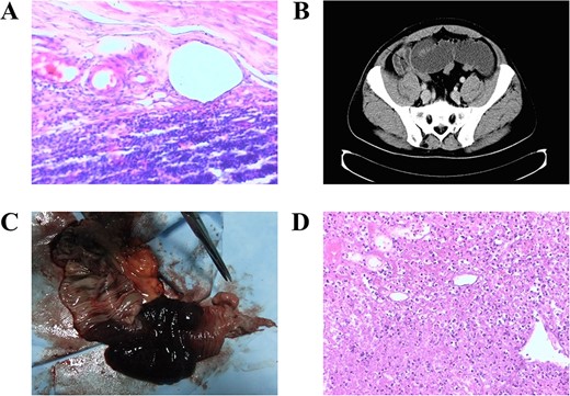 The representative pathological findings and imaging photos of the case. (A) The pathological examination showed acute suppurative appendicitis (Hematoxylin & Eosin staining, ×100). (B) Abdominal CT scan reveals evidence of small intestine obstruction, characterized by the presence of a dilated small intestine with an air-fluid level, as indicated by a black arrow. (C) Resected specimen of the small bowel. (D) The pathological examination revealed the presence of acute purulent enteritis accompanied by intestinal necrosis (Hematoxylin & Eosin staining, ×100).