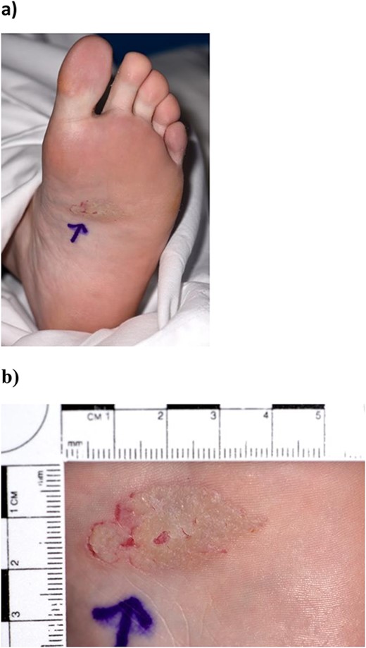 (a, b) Preoperative image of basal cell carcinoma on the sole of the foot, measuring 3.3×2 cm.
