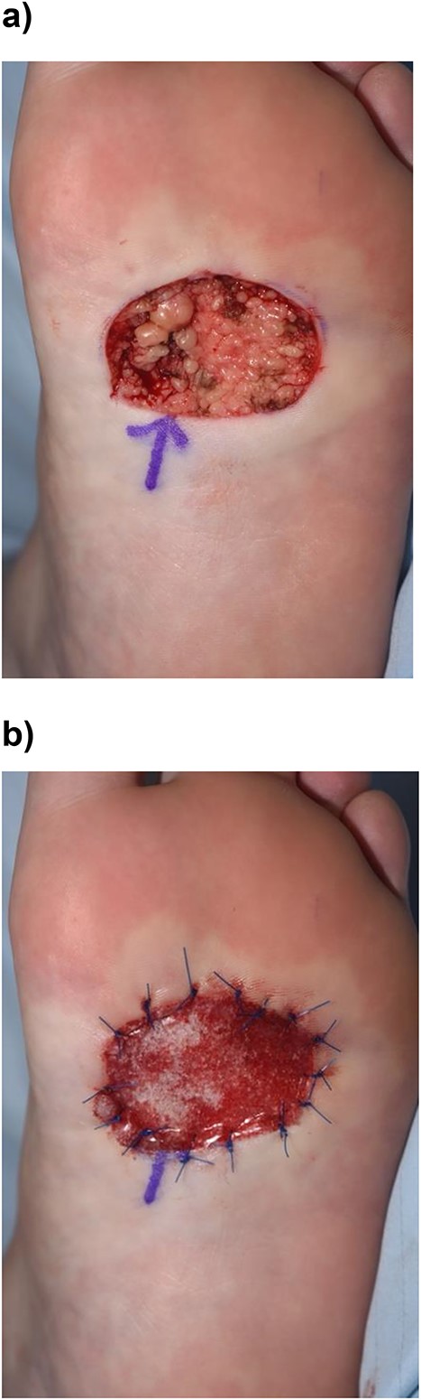 (a) Lesion was excised the depth of the plantar fascia. (b) Biodegradable Temporizing Matrix (Novosorb® BTM) covering the defect.