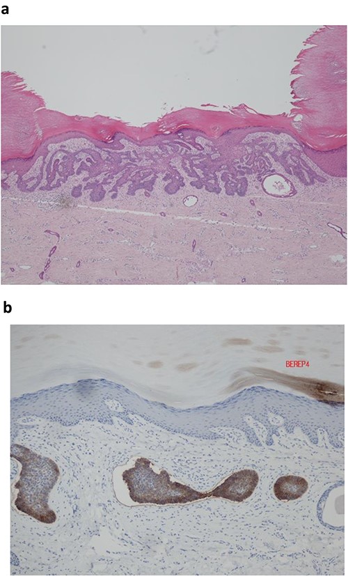 (a) Histopathological analysis showed an acral type skin containing a basaloid tumour with peripheral palisading and clefting artefact. (b) Ber EP4 immunohistochemistry positive.