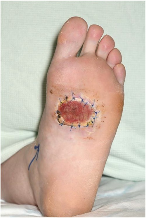 Split thickness skin graft covering defect and secured using 3/0 prolene sutures.