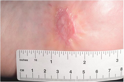 Post operative 2 months.