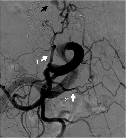 Iliac artery angiogram on opposite side of coil embolization procedure site at 6 months post-operation. The iliolumbar artery (white arrow 1), a branch of the internal iliac artery, and the lateral sacral artery (white arrow 2), a branch of the superior gluteal artery, are well developed and form a rich arcade. The black arrow indicates the sac refilling flow.