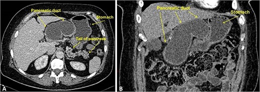 Contrast-enhanced CT, portal-venous phase: (A) axial; (B) frontal. The images demonstrate marked smooth cystic dilation of the head and neck region of the pancreas with duct dilation into the body (arrowheads), without mural nodules or side branch dilatation.