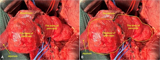 Intraoperative photo. (A) Fully mobilized head of the pancreas with the duodenum; (B) Yellow line marks the border of cystic lesions in the pancreas.