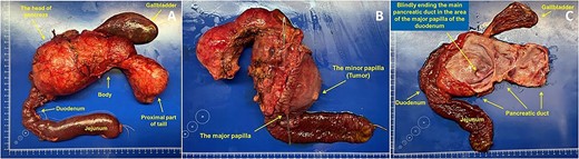 Image of the gross specimen: (A) general view; (B) rear view. Longitudinally dissected duodenum. Probe in the lumen of the CBD. (C) MPD opened longitudinally, the lumens of the gallbladder, duodenum, and jejunum were opened.