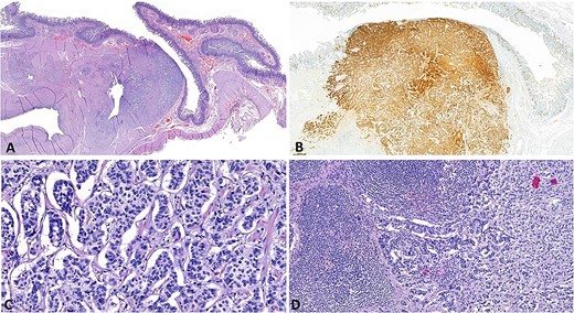 Microphoto: (A) NET in the area of the minor papilla (H and E, ×12); (B) cytoplasmic expression of chromogranin A (clone DAK-A3, DAKO) by tumor cells and enteroendocrine cells of the duodenal mucosa (DAB, H × 30); (C) Solid, trabecular and nested structure tumor of medium-sized polygonal cells with rounded nuclei with fine chromatin. Mitotic count is up to 1 per 2 mm2 (H and E, × 40); (D) Metastasis of the NET to a regional lymph node (H and E, × 200).