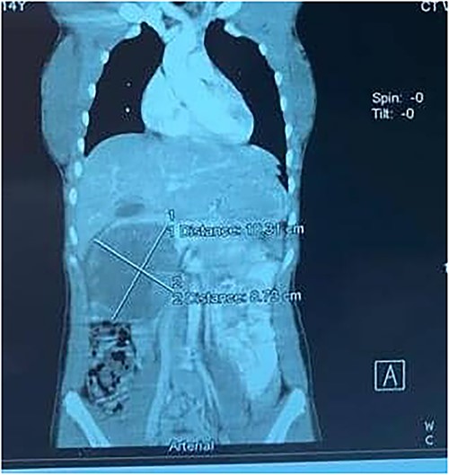 A contrast-enhanced CT scans of the abdomen showing a large, well-defined, and heterogeneous tumor.