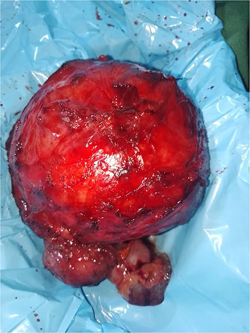 Anatomical piece showing a well-defined resected tumor.