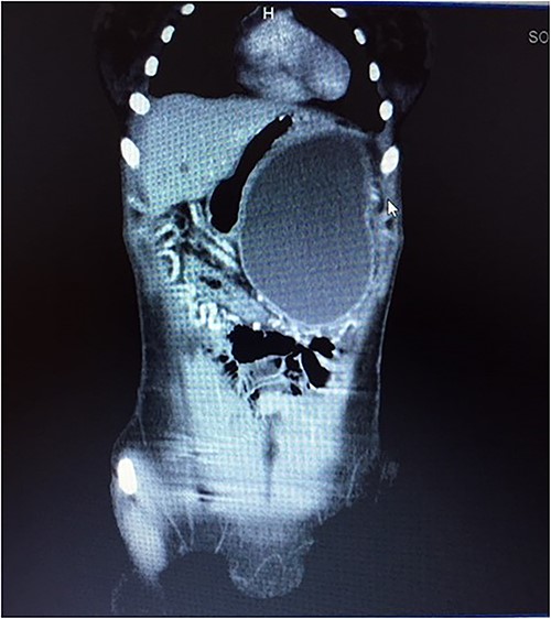 CT scan showing mass with well-defined borders.