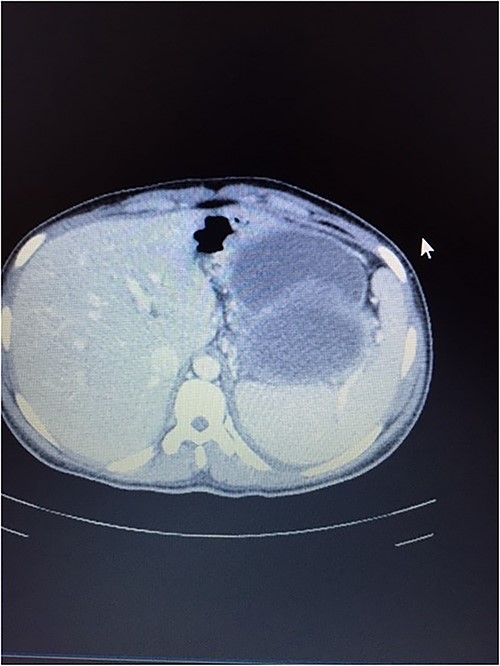 CT scan showing normal liver and enlarged spleen in close proximity with the mass.