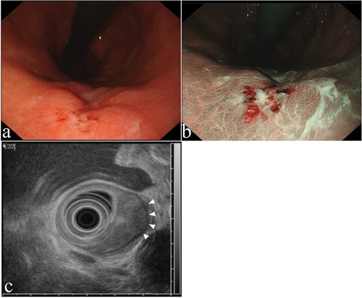 Upper gastrointestinal endoscopy findings. (a) 15-mm 0-IIc lesion, (b) narrow-band imaging. (c) Endoscopic ultrasound image revealed a low-echoic lesion with invasion of the muscularis propria layer (arrowheads).