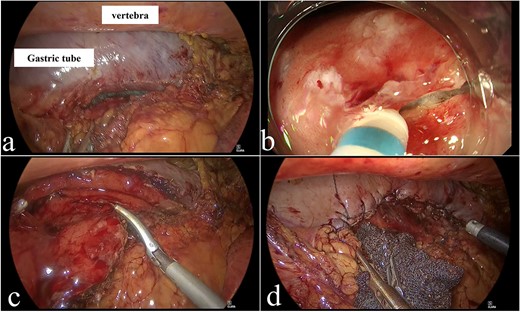 Operative findings. (a) Adhesion detachment was performed to expose the gastric tube. (b) Submucosal dissection using Dual Knife. (c) Resection of specimen using ultrasonic energy device. (d) Complete closure of wall defect using barbed sutures.