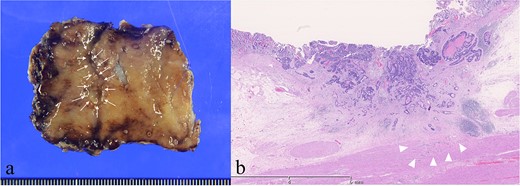 Histopathological findings. (a) Resected specimen. 13 × 8 mm 0-IIc lesion (arrows). (b) The tumor invaded muscularis propria (arrowheads) (Hematoxylin and Eosin staining).