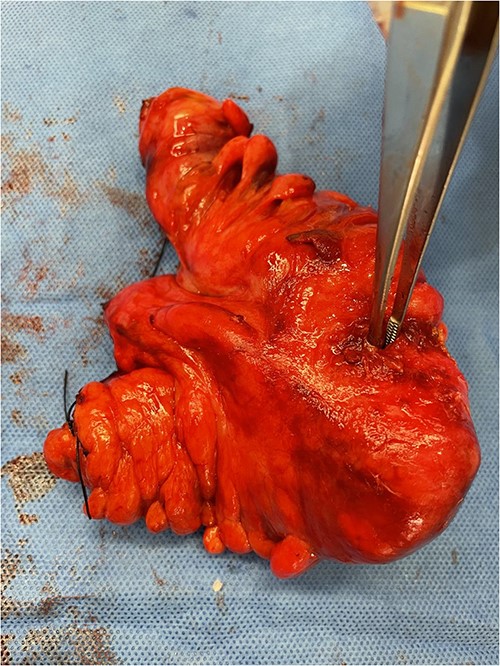Image of the specimen containing resected sigmoid colon. A forcep is used to display the defect in the sigmoid colon wall.