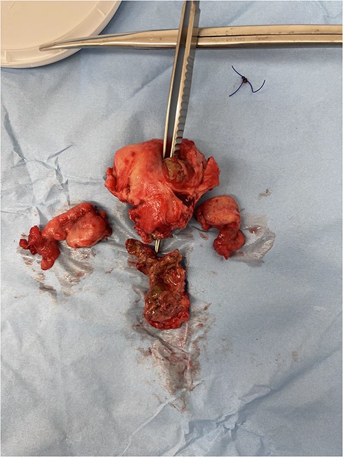 Image of the specimen containing resected uterus and bilateral ovaries. A forcep is seen probing through all layers of the uterus wall.