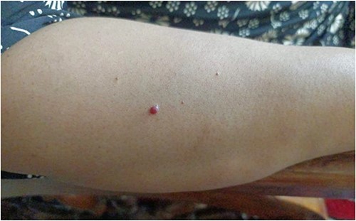 Multiple cherry hemangiomas on the dorsal side of right forearm.