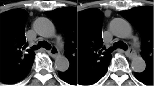 Chest computed tomography showing a small nodule with a diameter of 6 mm at the anterior mediastinum (A); after 2 years, the nodule had enlarged to 13 mm (B).