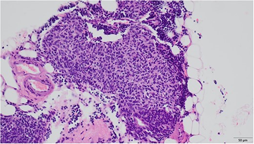 Microscopic findings revealed nodular hyperplasia of the thymic epithelium with a diameter of 400 μm.