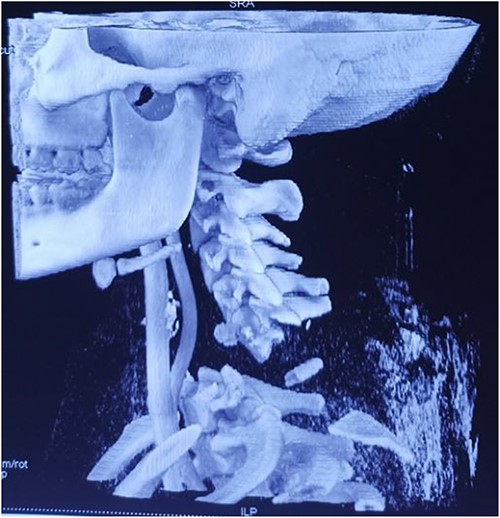 Computed tomography finding (3D reconstruction): C6/C7 dislocation.
