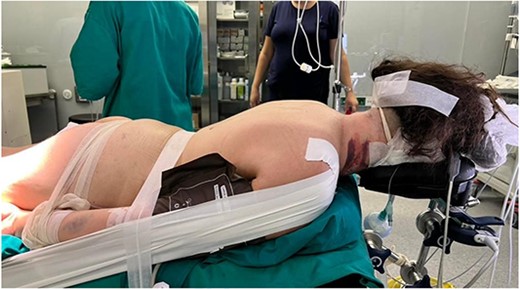 Position of the patient during surgery – posterior approach.